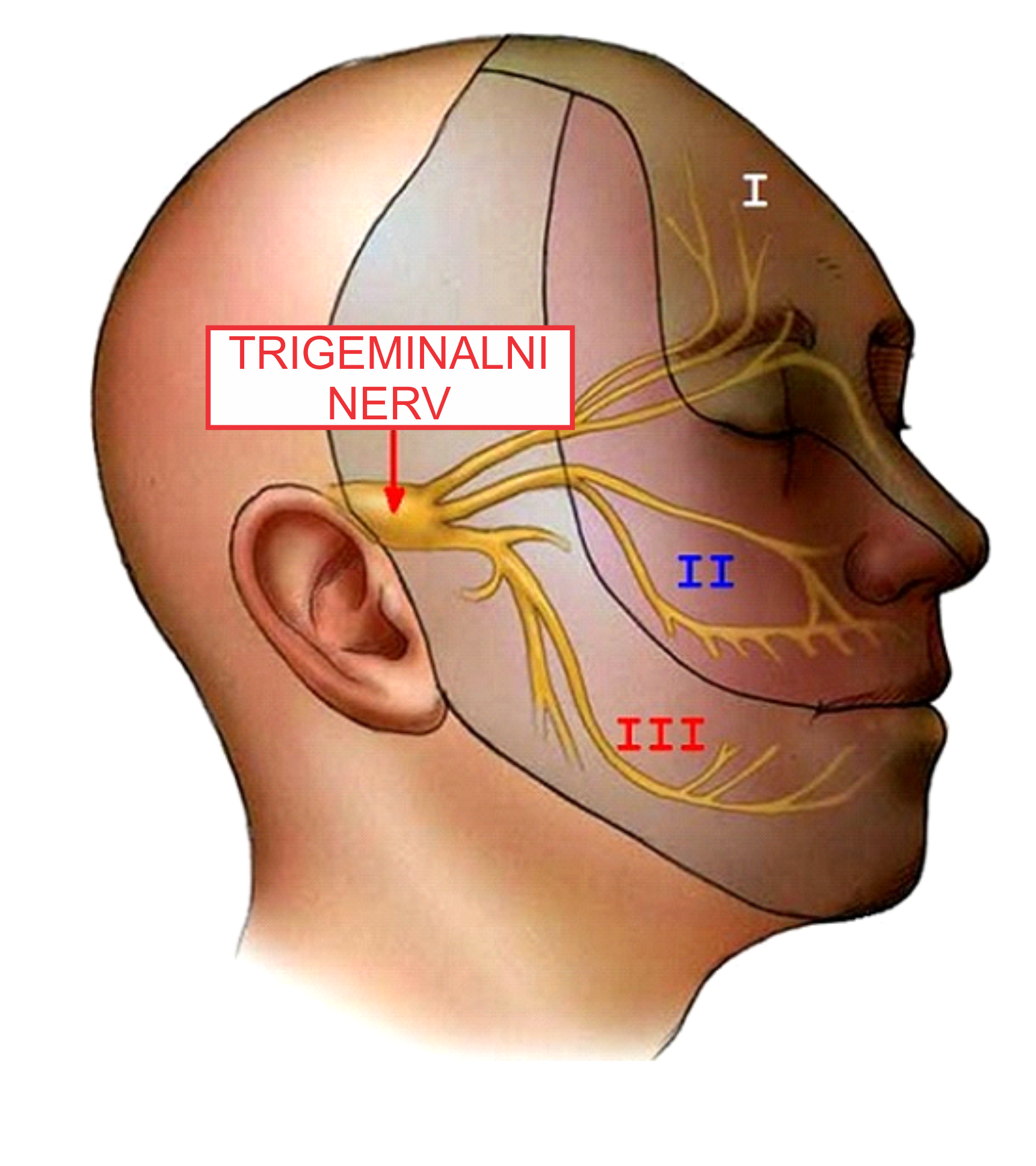 Trigeminalna neuralgija slika